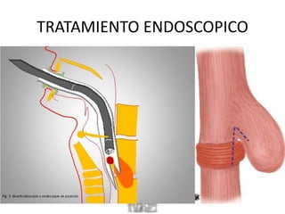 TRATAMIENTO ENDOSCOPICO
 