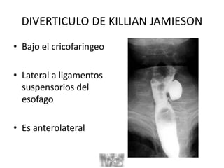 DIVERTICULO DE KILLIAN JAMIESON
• Bajo el cricofaringeo
• Lateral a ligamentos
suspensorios del
esofago
• Es anterolateral
 