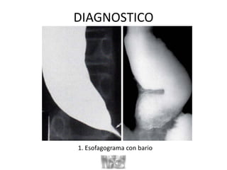 DIAGNOSTICO
1. Esofagograma con bario
 