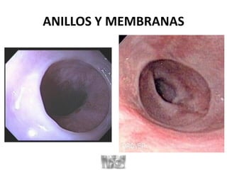 ANILLOS Y MEMBRANAS
 