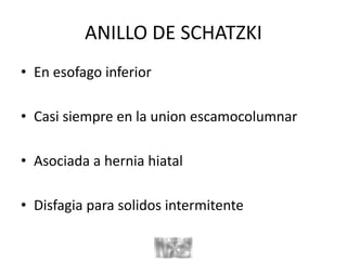 ANILLO DE SCHATZKI
• En esofago inferior
• Casi siempre en la union escamocolumnar
• Asociada a hernia hiatal
• Disfagia para solidos intermitente
 