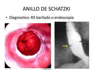 ANILLO DE SCHATZKI
• Diagnostico: RX baritado o endoscopia
 
