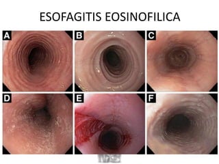 ESOFAGITIS EOSINOFILICA
 