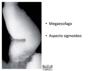 • Megaesofago
• Aspecto sigmoideo
 