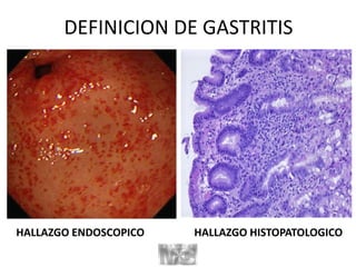 DEFINICION DE GASTRITIS
HALLAZGO ENDOSCOPICO HALLAZGO HISTOPATOLOGICO
 