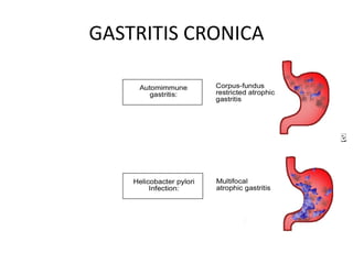 GASTRITIS CRONICA
GASTRITIS
TIPO “A”
GASTRITIS
TIPO “B”
 