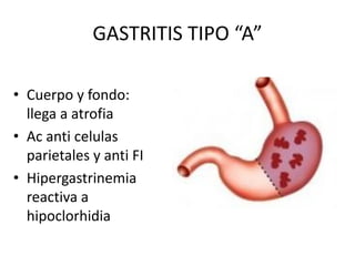 GASTRITIS TIPO “A”
• Cuerpo y fondo:
llega a atrofia
• Ac anti celulas
parietales y anti FI
• Hipergastrinemia
reactiva a
hipoclorhidia
 