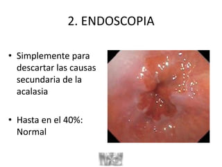 2. ENDOSCOPIA
• Simplemente para
descartar las causas
secundaria de la
acalasia
• Hasta en el 40%:
Normal
 