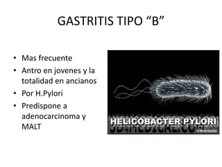 GASTRITIS TIPO “B”
• Mas frecuente
• Antro en jovenes y la
totalidad en ancianos
• Por H.Pylori
• Predispone a
adenocarcinoma y
MALT
 