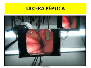 ULCERA PÉPTICA
 