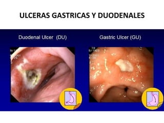 ULCERAS GASTRICAS Y DUODENALES
 