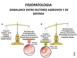 FISIOPATOLOGIA
DISBALANCE ENTRE FACTORES AGRESIVOS Y DE
DEFENSA
 