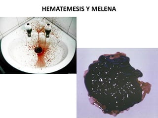 HEMATEMESIS Y MELENA
 