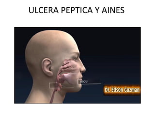 ULCERA PEPTICA Y AINES
 