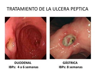 TRATAMIENTO DE LA ULCERA PEPTICA
DUODENAL GÁSTRICA
IBPs: 4 a 6 semanas IBPs: 8 semanas
 