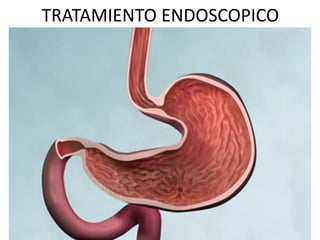 TRATAMIENTO ENDOSCOPICO
 