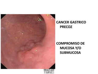 CANCER GASTRICO
PRECOZ
COMPROMISO DE
MUCOSA Y/O
SUBMUCOSA
 