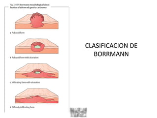 CLASIFICACION DE
BORRMANN
 