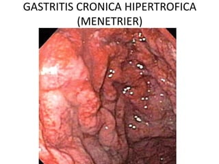GASTRITIS CRONICA HIPERTROFICA
(MENETRIER)
 