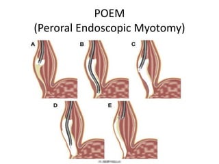POEM
(Peroral Endoscopic Myotomy)
 