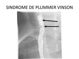 SINDROME DE PLUMMER VINSON
 