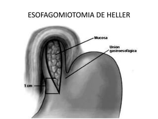 ESOFAGOMIOTOMIA DE HELLER
 
