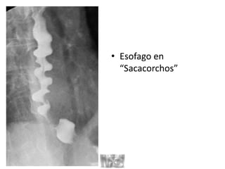 • Esofago en
“Sacacorchos”
 