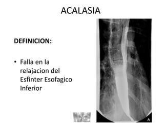 ACALASIA
DEFINICION:
• Falla en la
relajacion del
Esfinter Esofagico
Inferior
 