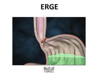ERGE
 