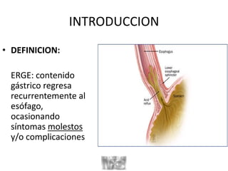 INTRODUCCION
• DEFINICION:
ERGE: contenido
gástrico regresa
recurrentemente al
esófago,
ocasionando
síntomas molestos
y/o complicaciones
 