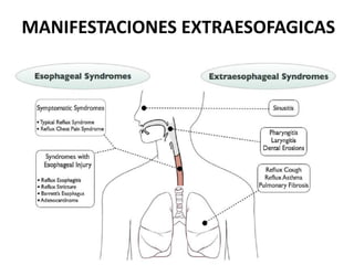 MANIFESTACIONES EXTRAESOFAGICAS
 