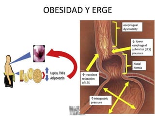 OBESIDAD Y ERGE
 