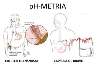 pH-METRIA
CATETER TRANSNASAL CAPSULA DE BRAVO
 