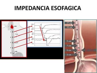 IMPEDANCIA ESOFAGICA
 