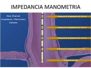 IMPEDANCIA MANOMETRIA
 