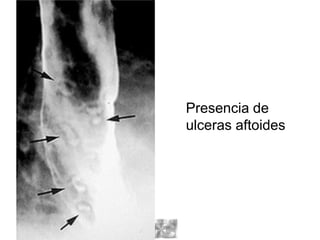 Presencia de
ulceras aftoides
 