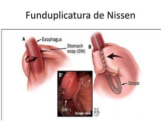 Funduplicatura de Nissen
 