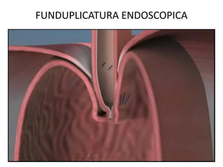 FUNDUPLICATURA ENDOSCOPICA
 