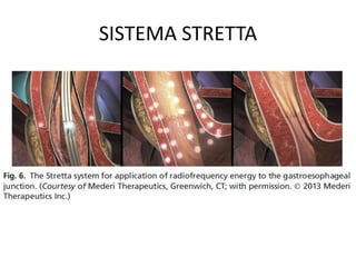 SISTEMA STRETTA
 