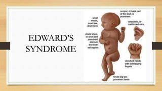 EDWARD’S
SYNDROME
 