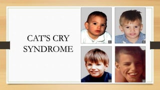 CAT’S CRY
SYNDROME
 