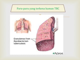 
Paru-paru yang terkena kuman TBC
 