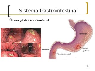 Sistema Gastrointestinal
34
Úlcera gástrica e duodenal
 