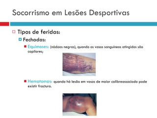 Socorrismo em Lesões Desportivas Tipos de feridas: Fechadas: Equimoses:  (nódoas negras), quando os vasos sanguíneos atingidos são capilares; Hematomas:   quando há lesão em vasos de maior calibreassociado pode existir fractura. 