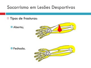 Socorrismo em Lesões Desportivas Tipos de fracturas: Aberta; Fechada. 