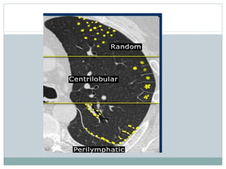 lung hrct patterns | PPT