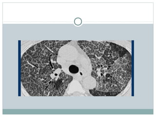 lung hrct patterns | PPT