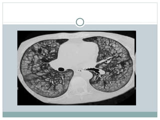 lung hrct patterns | PPT