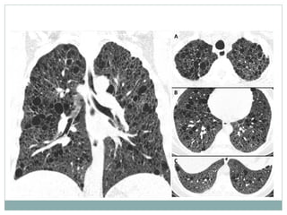 lung hrct patterns | PPT