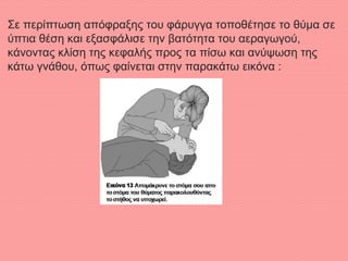 Σε περίπτωση απόφραξης του φάρυγγα τοποθέτησε το θύμα σε
ύπτια θέση και εξασφάλισε την βατότητα του αεραγωγού,
κάνοντας κλίση της κεφαλής προς τα πίσω και ανύψωση της
κάτω γνάθου, όπως φαίνεται στην παρακάτω εικόνα :
 